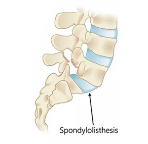 Spondylolisthesis