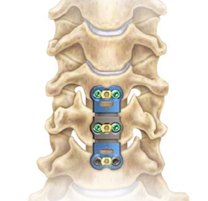 Anterior Cervical-Discectomy-Fusion