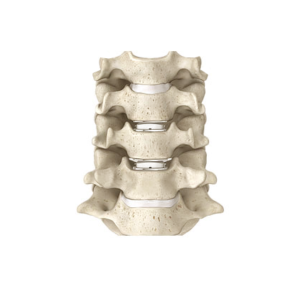 Cervical-Disc-Replacement