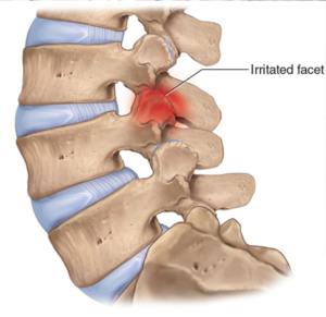 Facet-Disease