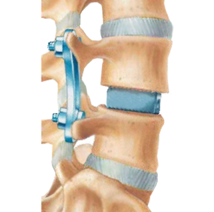 Lateral-Lumbar-Interbody-Fusion