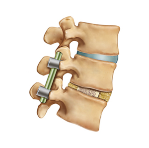 Transforaminal Lumbar Interbody Fusion