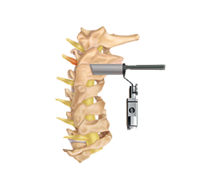 foraminotomy