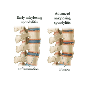 spondylitis