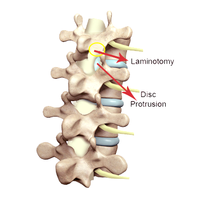 Laminotomy Procedure | Minimally Invasive | Spine Laser Institutes