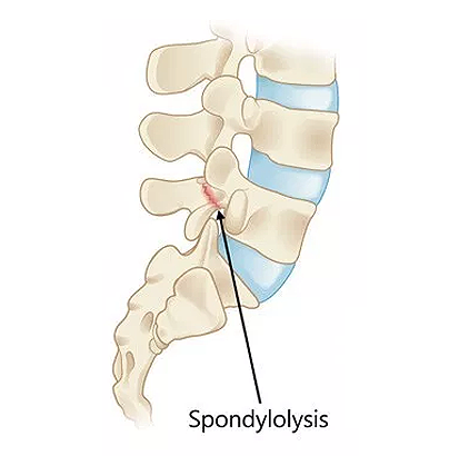 Spondylosis | Causes & Symptoms | Spine Laser Institutes